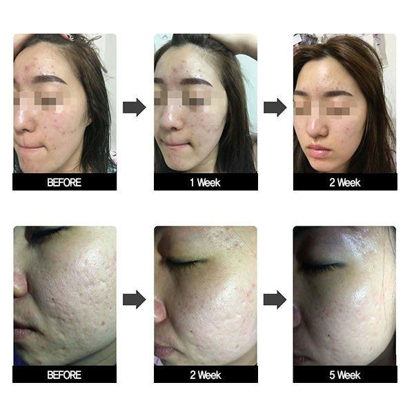 CF Magic LED Mask (360 LED) - Health Korea Shop